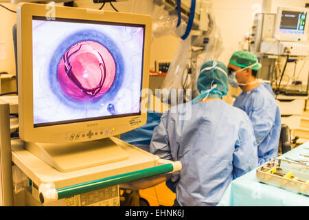 La chirurgie de la cataracte, l'installation de l'implant intraoculaire, l'hôpital de Bordeaux, France. Banque D'Images