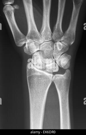 X-Ray de syndrome du canal carpien et l'os métacarpien de la main de l'Homme Banque D'Images