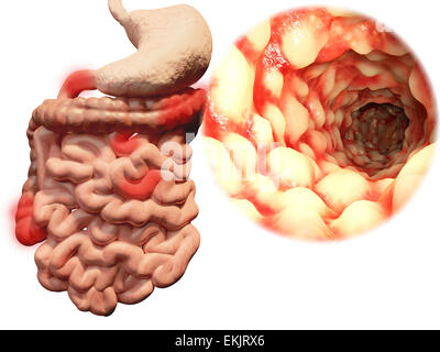 La maladie de Crohn'ss, l'appareil digestif, les maladies inflammatoires de l'intestin, l'intestin, coloscopie, colon, intestin grêle, estomac, gros intestin, système digestif, l'intestin, orgue, duodénum, l'iléon, médecine, médecine, anormales, malsaine, fond blanc Banque D'Images