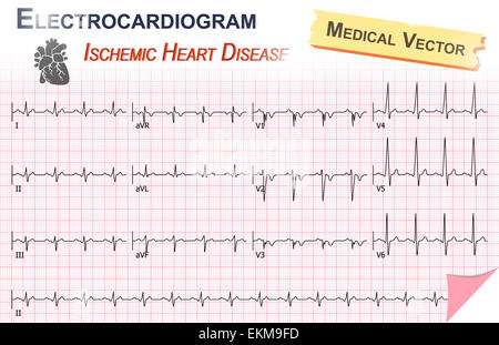 Électrocardiogramme ECG EKG ( , ) de la maladie cardiaque ischémique (infarctus du myocarde) et l'anatomie de l'icône en forme de cœur Banque D'Images