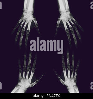Xray grâce à des profils de la main et du poignet avec radius et cubitus os traitement de diagnostic doigts pouce Banque D'Images