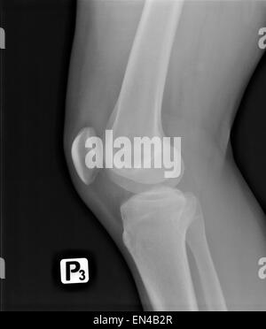 X-ray image numérisée radiologie jeune homme de blessure à la jambe Banque D'Images