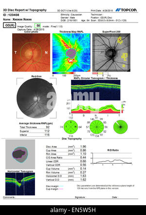 Eye test sonore ultra numérisation 3D montrant MACULA Rapport de l'œil humain vist diverses représentations graphiques. Banque D'Images