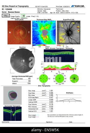 Eye test sonore ultra numérisation 3D montrant MACULA Rapport de l'œil humain vist diverses représentations graphiques. Banque D'Images