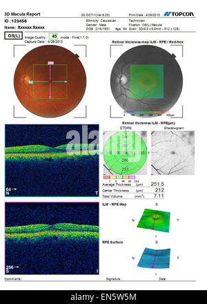 Eye test sonore ultra numérisation 3D montrant MACULA Rapport de l'œil humain vist diverses représentations graphiques. Banque D'Images