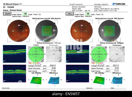 Eye test sonore ultra numérisation 3D montrant MACULA Rapport de l'œil humain vist diverses représentations graphiques. Banque D'Images