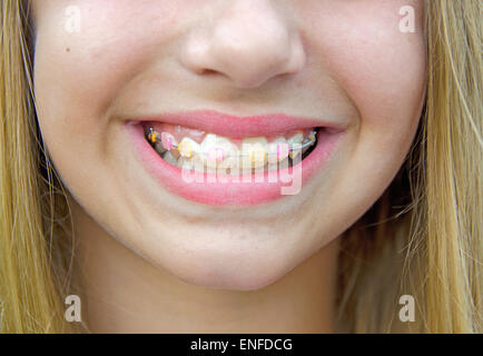 Jeune fille avec accolades orthodontique sur ses dents. Banque D'Images