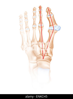 Hallux valgu Banque D'Images