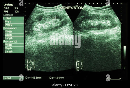 De l'échographie des reins : show rein gauche pierre ( 2 image pour comparer ) Banque D'Images