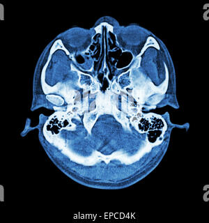 Scanographie du cerveau et du crâne de base ( Bone ) Banque D'Images