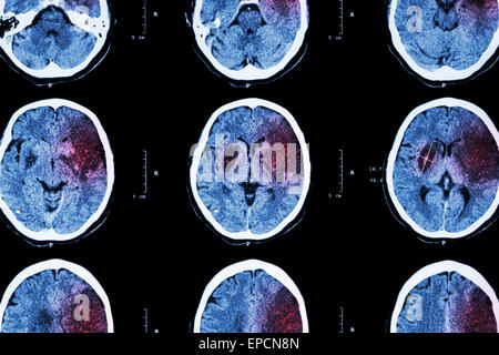 Avc ischémique : ( CT de cerveau indiquent l'infarctus cérébral à gauche - frontal - temporal lobe pariétal ) ( système nerveux central backgroun Banque D'Images