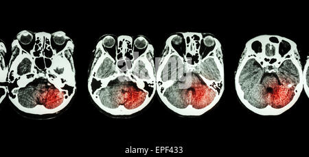 ( CT scan de cerveau et la base du crâne et l'accident vasculaire cérébral ) Banque D'Images