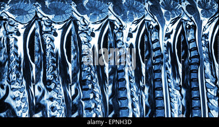 La spondylose cervicale avec hernie discale ( IRM de rachis cervical : montrer la spondylose cervicale hernie discale avec spin compress Banque D'Images