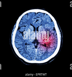 CT scan du cerveau indiquent d'un accident vasculaire cérébral ischémique ou hémorragique avc Banque D'Images