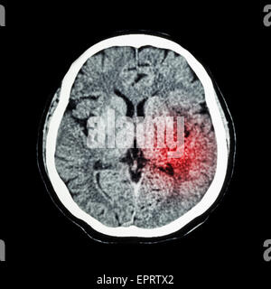 CT scan du cerveau indiquent d'un accident vasculaire cérébral ischémique ou hémorragique avc Banque D'Images