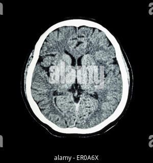 CT scan de cerveau : montrer l'humain normal CAT scan ( cerveau ) Banque D'Images