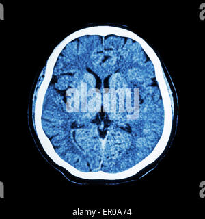 CT scan de cerveau : montrer l'humain normal CAT scan ( cerveau ) Banque D'Images