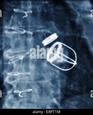 Valves cardiaques artificielles. X-ray de couleur de la poitrine d'un patient de 59 ans avec une insuffisance cardiaque qui a eu à la fois la valve mitrale et aortique de leur coeur remplacés par des valves cardiaques artificielles. Banque D'Images