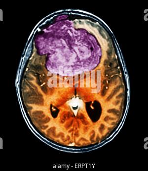 Tumeur bénigne au cerveau. La tomodensitométrie (CT de couleur) du cerveau d'un patient de 25 ans avec un méningiome (violet). Il s'agit d'une bénigne (non cancéreuse) tumeur qui découle de la méninges, les membranes qui entourent le cerveau. Il a été causé par ra Banque D'Images