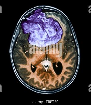 Tumeur bénigne au cerveau. La tomodensitométrie (CT de couleur) du cerveau d'un patient de 25 ans avec un méningiome (violet). Il s'agit d'une bénigne (non cancéreuse) tumeur qui découle de la méninges, les membranes qui entourent le cerveau. Il a été causé par ra Banque D'Images