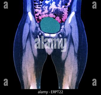 Couleur scanner de la vessie pleine en bonne santé (vert) d'un patient de 45 ans. Banque D'Images