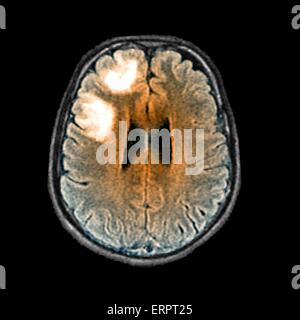 Une touche de couleur l'imagerie par résonance magnétique (IRM) d'une section à travers le cerveau d'un patient âgé de 60 ans avec la leucoencéphalopathie multifocale progressive (LEMP). Cette maladie conduit à la destruction de la myéline autour des nerfs dans le cerveau de la matière blanche. Banque D'Images