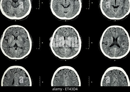 CT scan du cerveau indiquent un cerveau normal ( contexte neurologique ) Banque D'Images