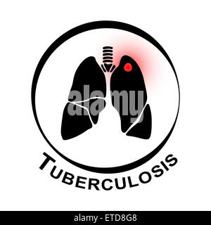 La tuberculose pulmonaire ( à gauche de la cavité pulmonaire avec le lobe supérieur en raison de l'infection à Mycobacterium tuberculosis ) Banque D'Images