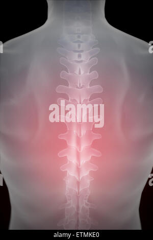 Illustration montrant l'épine dans le dos, halo rouge pour indiquer la douleur. Banque D'Images