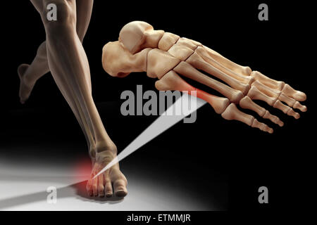 Illustration montrant une figure d'exécution avec les os du pied en surbrillance. Un zoom arrière section montre une coupure d'un métatarsien. Banque D'Images