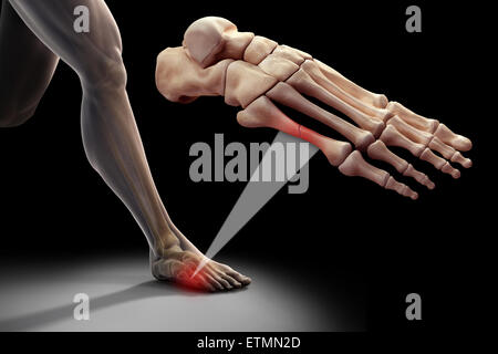 Illustration montrant une figure d'exécution avec les os du pied en surbrillance. Un zoom arrière section montre une coupure d'un métatarsien. Banque D'Images