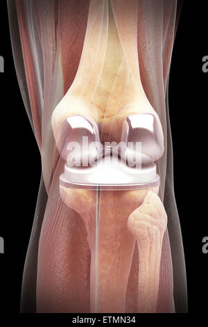 Illustration montrant une arthroplastie du genou avec muscle transparent. Banque D'Images