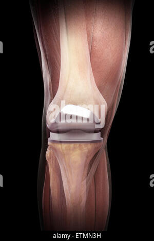 Illustration montrant une arthroplastie du genou avec muscle transparent. Banque D'Images