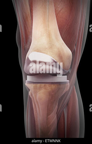 Illustration montrant une arthroplastie du genou avec muscle transparent. Banque D'Images