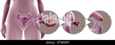 Illustration de la ligature des trompes de Fallope par la méthode Pomeroy, qui supprime une section du tube pour empêcher la fécondation. Banque D'Images