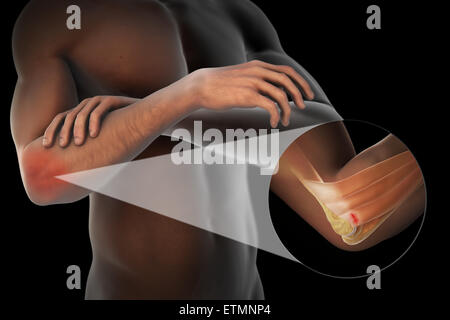 Illustration du bras avec peau transparente pour montrer un dommage à l'épicondyle latéral du tendon, connu sous le nom de l'épicondylite latérale ou le coude de tennis. Banque D'Images