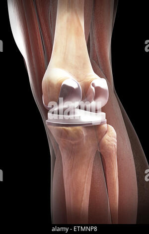 Illustration montrant une arthroplastie du genou avec muscle transparent. Banque D'Images