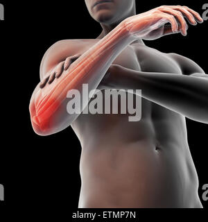 Illustration du bras avec peau transparente pour montrer un dommage à l'épicondyle latéral du tendon, connu sous le nom de l'épicondylite latérale ou le coude de tennis. Banque D'Images