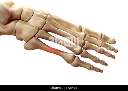 Illustration montrant l'os du pied avec une coupure d'un métatarsien en surbrillance. Banque D'Images