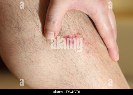 La blessure sur la jambe de l'homme Banque D'Images