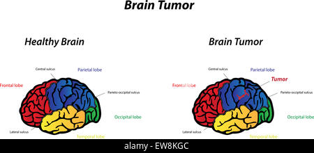 Tumeur au cerveau Banque D'Images