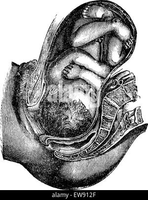 L'engagement et la descente de la tête, vintage engraved illustration. Magasin Pittoresque 1875. Illustration de Vecteur