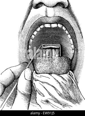 La laryngoscopie, montrant une vue dans la gorge du patient, vintage engraved illustration. Dictionnaire de médecine habituelle par le Dr Labarthe - 18 Illustration de Vecteur