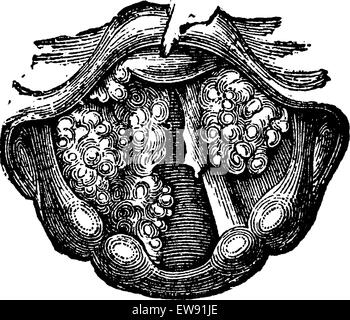 Plusieurs symptômes du larynx, vintage engraved illustration. Dictionnaire de médecine habituelle par le Dr Labarthe - 1885 Illustration de Vecteur