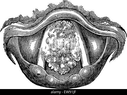 De myxome du larynx, vintage engraved illustration. Dictionnaire de médecine habituelle par le Dr Labarthe - 1885 Illustration de Vecteur