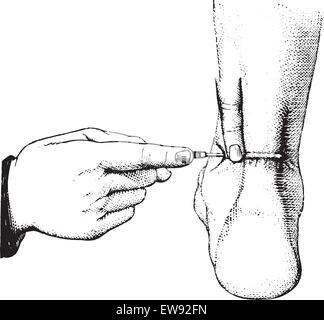 Ténotomie du tendon d'Achille, vintage engraved illustration. Dictionnaire de médecine habituelle par le Dr Labarthe - 1885. Illustration de Vecteur