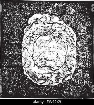 Calcul de l'urate de sodium dans enchaton la muqueuse vésicale et extraites par prerectale taille, vintage engraved illustration. Us Illustration de Vecteur