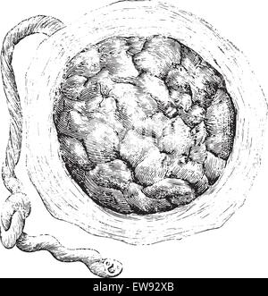 Placenta (externe ou du côté de l'utérus), vintage engraved illustration. Dictionnaire de médecine habituelle par le Dr Labarthe - 1885. Illustration de Vecteur