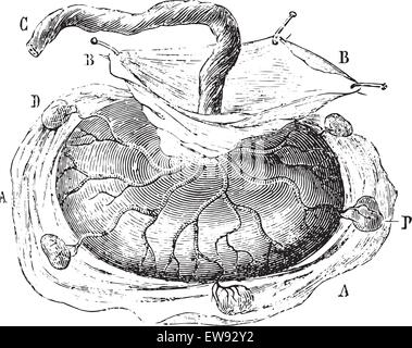 Placenta avec cinq cotylédons isolés, vintage engraved illustration. Dictionnaire de médecine habituelle par le Dr Labarthe - 1885. Illustration de Vecteur