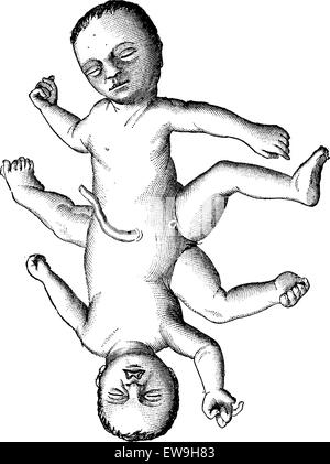 Ischiopagi ou jumeaux siamois united au bassin, vintage engraved illustration. Dictionnaire de médecine habituelle par le Dr Labarthe - 18 Illustration de Vecteur